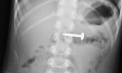 Cháu bé 5 tuổi suýt thủng ruột vì nuốt đinh vít nhọn