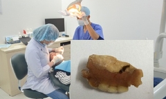 Thấy tức ngực, khó thở đi khám phát hiện răng giả chui vào dạ dày
