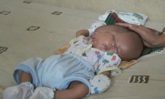 Xót xa bé sơ sinh gặp nguy hiểm vì có hai khuôn mặt, hai bộ não trên cùng một cơ thể