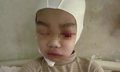 Nói chuyện trong lớp, nam sinh Trung Quốc bị thầy giáo giật tóc tới chấn thương sọ não
