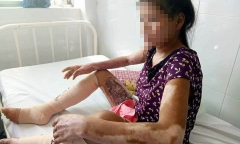 Chồng sắp cưới ôm tiền từ thiện bỏ mặc vợ mang thai bị bỏng nặng