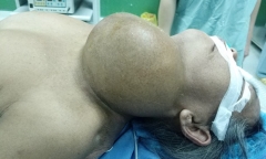 Cắt bỏ thành công khối u nặng 2kg nằm trên cổ bệnh nhân suốt 40 năm