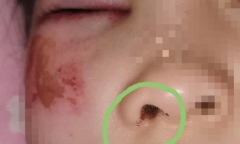 Nữ sinh 8 tuổi bị cô giáo đánh suýt mù mắt, nguyên nhân gây phẫn nộ