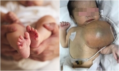 Tin tức đời sống mới nhất ngày 13/11: Cắt khối u khổng lồ cho bé 3 ngày tuổi