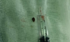 Tin tức đời sống ngày 3/1: Mảnh gỗ nằm trong má suốt 14 năm mà không biết