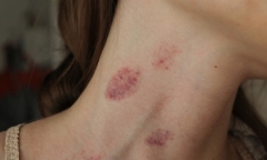 Hickey: Vết