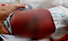 Sưởi ấm bằng than, bé 13 ngày tuổi bị bỏng nặng, nhiễm trùng máu