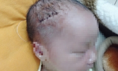 Gia đình hoảng hốt khi đón bé trai sơ sinh từ phòng mổ với 6 mũi khâu trên đầu