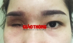 Cô gái mù vĩnh viễn một bên mắt vì nâng mũi bằng chất làm đầy