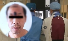 Người đàn ông bị ung thư ác tính do tự ý nặn mụn trên trán