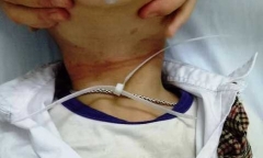 Bị dây nhựa thít chặt cổ, bé trai 6 tuổi suy hô hấp cấp suýt tử vong