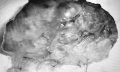 Khối u to như cái bát trong lồng ngực được bác sĩ viện K bóc tách thành công