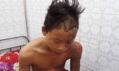 Bị sét đánh trúng đầu, cậu bé Thanh Hóa may mắn thoát chết