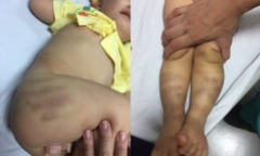 Tình hình sức khỏe của bé trai 1 tuổi bị bạo hành, bỏ lại bệnh viện