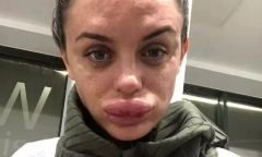 Bi hài hậu vận sau thẩm mỹ: 