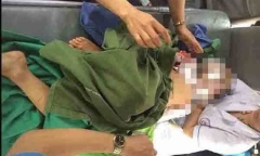 Bé trai 12 tuổi bị chó cắn lóc da đầu, mất 2 tai chuyển ra bệnh viện Việt Đức điều trị