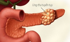 9 dấu hiệu giúp phát hiện ung thư tụy sớm mà mọi người thường bỏ qua
