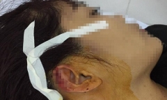 Giáo viên dạy khiêu vũ bị phụ huynh cắn đứt tai