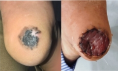 Nốt ruồi biến thành ung thư, người đàn ông phải khoét gót chân