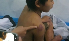 Đi chơi không xin phép, cậu bé 11 tuổi bị bố đánh dã man