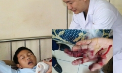 Nam sinh lớp 7 bị dập nát bàn tay vì tự chế pháo bằng diêm
