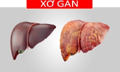 4 nguyên tắc phòng ngừa xơ gan dẫn đến ung thư gan