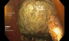 Ăn hồng ngâm nhai không kỹ, nữ bệnh nhân có 4 khối bã thức ăn to như quả trứng
