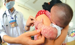 Biến chứng nguy hiểm khi mắc thuỷ đậu khiến nhiều bệnh nhân nhập viện dài ngày