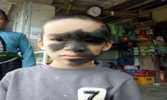 Số phận éo le của cậu bé 6 tuổi mang khuôn mặt 