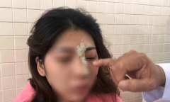 Tiêm filler nâng mũi tại spa, thiếu nữ 21 tuổi bị mù mắt
