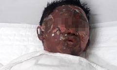 Tin mới nhất về sức khỏe cháu bé bị dì ruột tẩm xăng thiêu ở Bà Rịa - Vũng Tàu