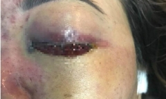Cảnh báo tai biến khiến chị em mù mắt, hoại tử mũi khi làm đẹp