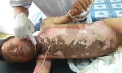 Tin tức đời sống mới nóng nhất ngày 23/5/2019: Trèo lên cột điện bắn chim, bé trai 10 tuổi bị bỏng nặng