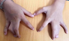 Dòng họ 4 đời bị dị tật bàn tay 