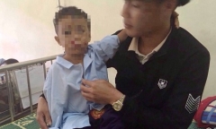 Đốt pin điện thoại, 2 anh em bị nổ nát bàn tay