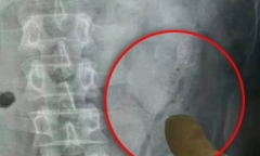 Bợm nhậu suýt chết vì 