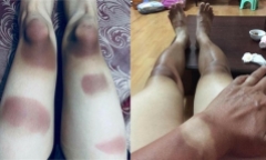 Dân mạng đua nhau khoe ảnh da cháy nắng mà không nghĩ tới hậu quả
