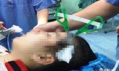 Nghệ An: Cứu sống bé gái bị bạn găm kéo nhọn vào đầu sâu 3cm