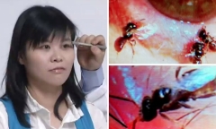 Kỳ lạ người phụ nữ có 4 con ong sống trong mắt