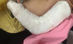 Phục hồi cánh tay dập nát của cháu bé 19 tháng bị xe tải cán ở Quảng Ninh