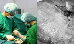 Tự uống lá thuốc điều trị suốt 4 năm vì sợ mổ, đến khi khối u xơ nặng tới 4kg