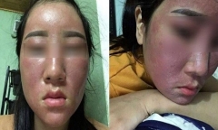 Những loại kem dưỡng trắng hủy hoại da không kém gì kem trộn vẫn đang 'che mắt' phái đẹp