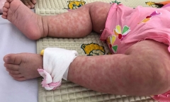 Hải Dương: Cô và trò trường tiểu học liên tiếp mắc sởi