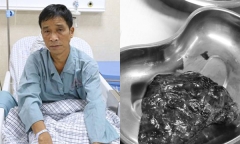 Bệnh nhân may mắn phát hiện bệnh ung thư phổi nhờ đi khám ho khan