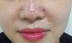 Tiêm filler tại spa, cô gái bị bầm tím vùng mũi