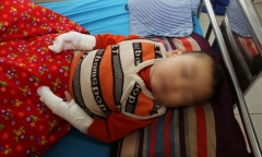 Cha mẹ lơ là, trẻ bị bỏng nước sôi nguy kịch ngày càng nhiều