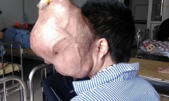 Khối u “ăn” não, người đàn ông đau đớn đợi phẫu thuật