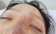 Tiêm filler giá rẻ ở spa, thiếu nữ có nguy cơ mù mắt