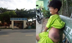 Đánh học sinh khuyết tật bầm tím, nữ giáo viên bị tạm đình chỉ 15 ngày