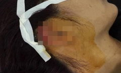 Hé lộ nguyên nhân nữ giáo viên dạy khiêu vũ bị phụ huynh cắn đứt tai